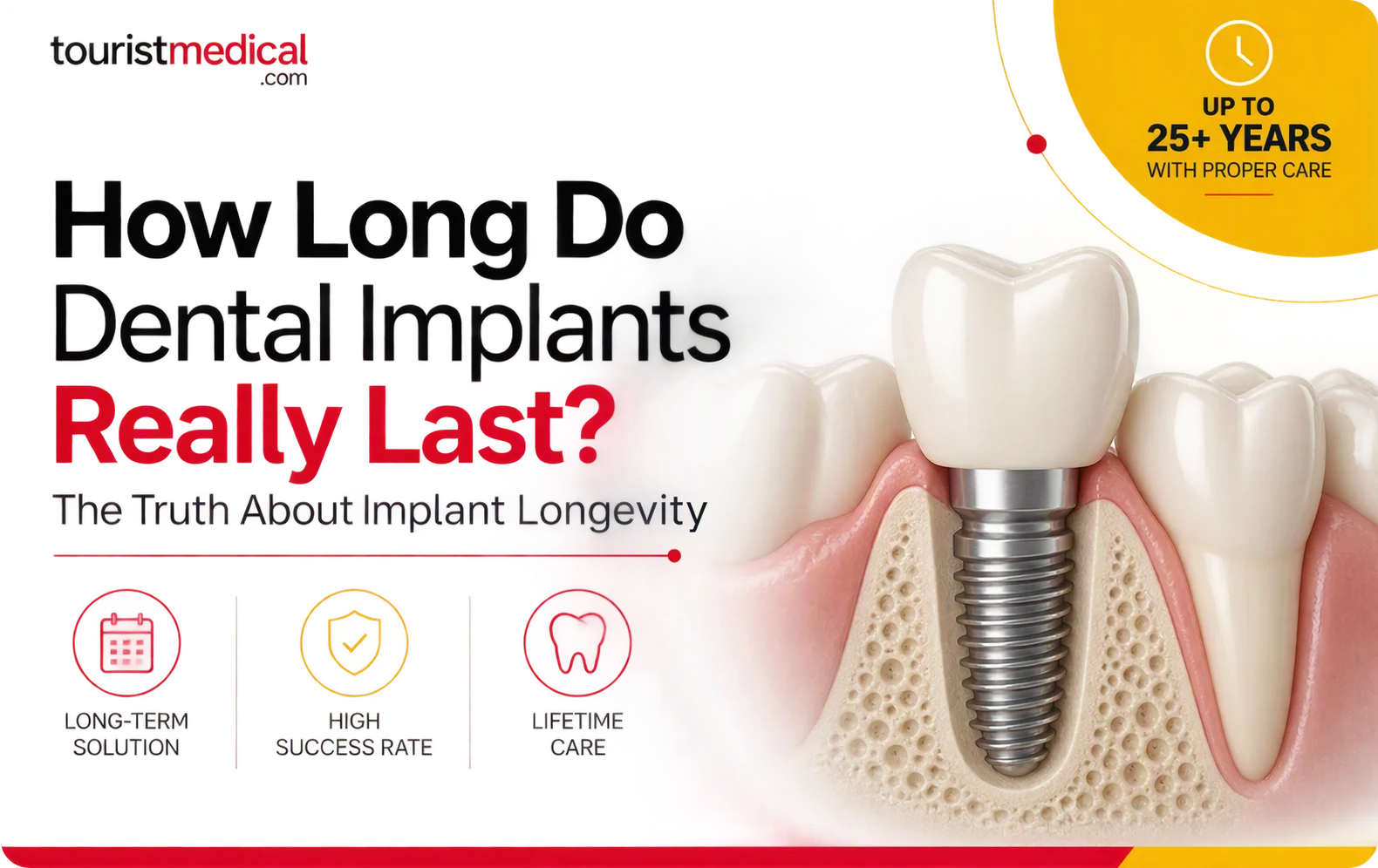 How Long Do Dental Implants Really Last?